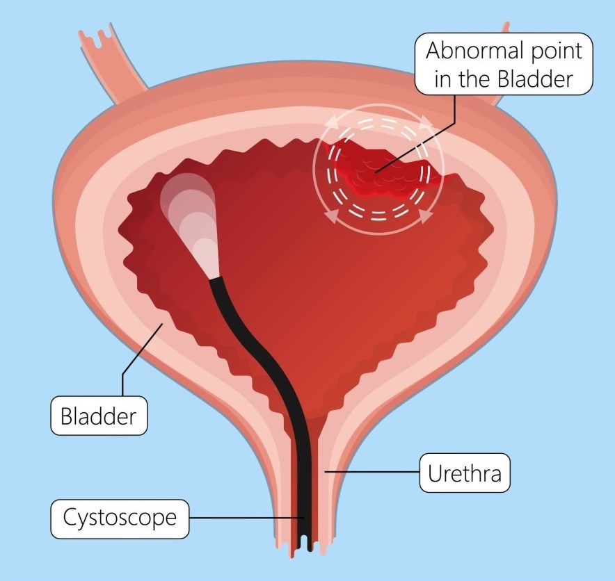 urinary-tract-infections-rosemaryconley-com